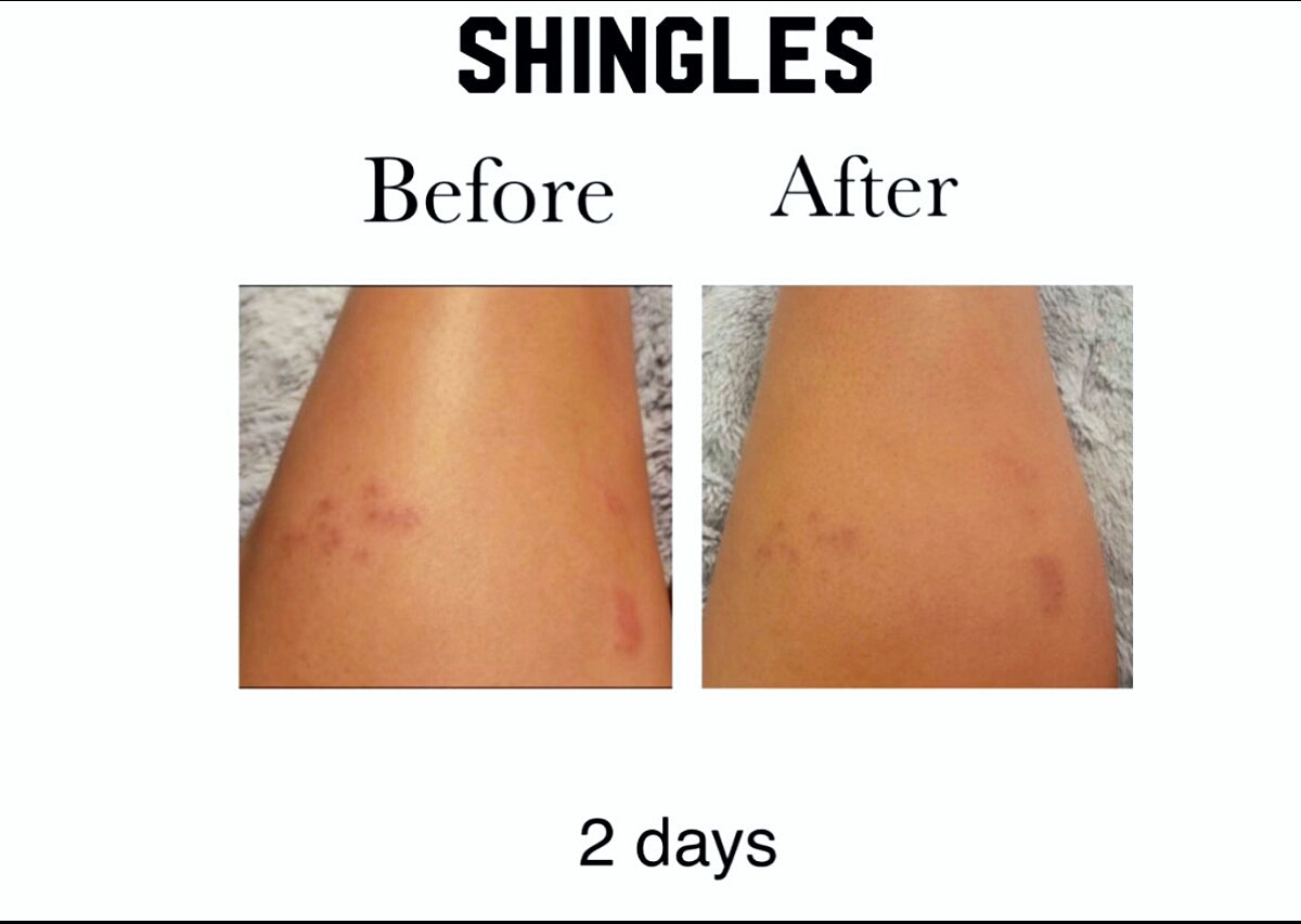 Ms Bee'z Beauty skin oil before and after results on shingles rash